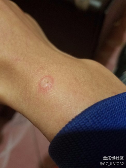 手机发烫,烫伤手臂.